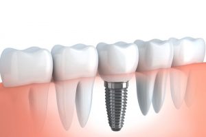 Dental Implants