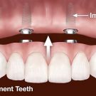 Dentures Of The Future May Be Real Teeth